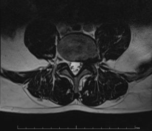 Hernie discale foraminale L4L5 gauche sur coupe axiale IRM