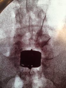 Infiltration articulaire postérieure au dessus d'une prothèse discale