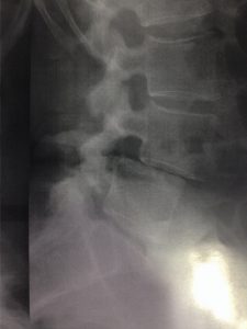 Spondylolisthésis L4L5 dégénératif, entrainant une sténose canalaire