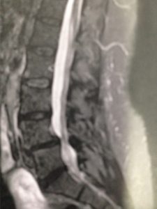 Exploration par IRM du même spondylolisthésis