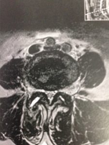 Vue axiale du spondylolisthésis L4L5 compliqué d'un rétrécissement du canal