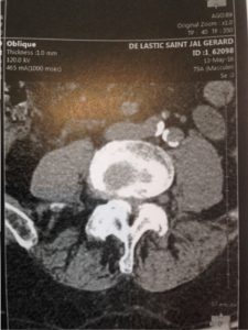 Coupe axial au scanner d'un canal lombaire étroit