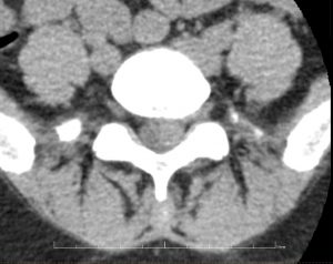 Volumineuse hernie discale L5S1 paramédiane gauche visualisée au scanner