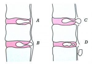  Différents types de hernie discale