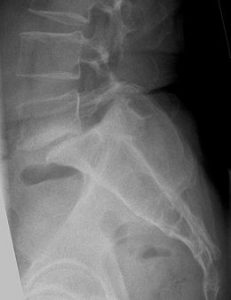 Spondylolisthésis de L5 sur S1 par lyse isthmique de L5 bilatérale