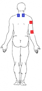 Névralgie cervico-brachiale