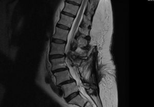 Syndrome jonctionnel au dessus d'une arthrodèse L3L4L5