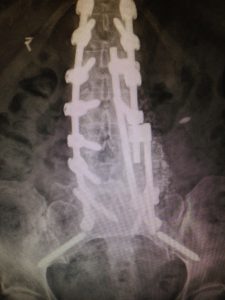 Fracture des vis au niveau du sacrum. Le remplacement des vis fracturées résoudra le problème.